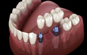 4 Benefits of Dental Implants