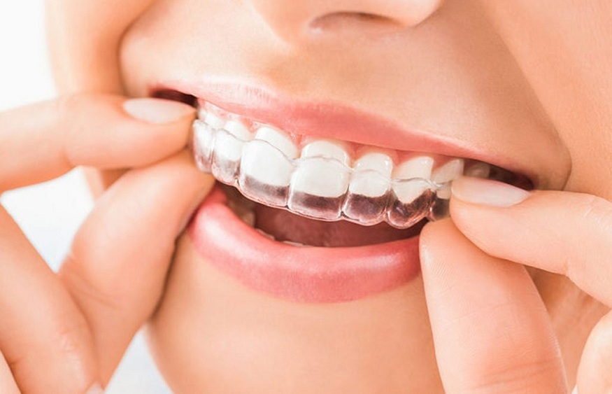 Braces Cost in India: A Complete Guide